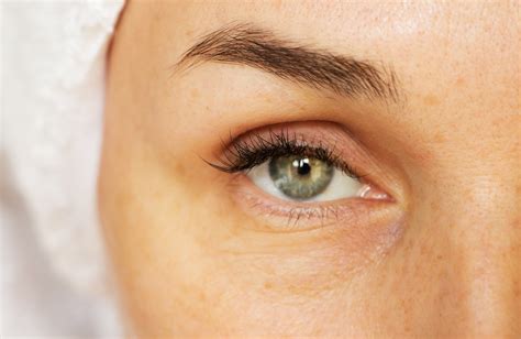 The Magical and Wrinkle-Erasing Benefits of Under Eye Fillers - My ...