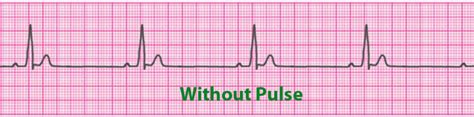 ACLS Cardiac EKG Arrhythmias and Treatments Cheat Sheet