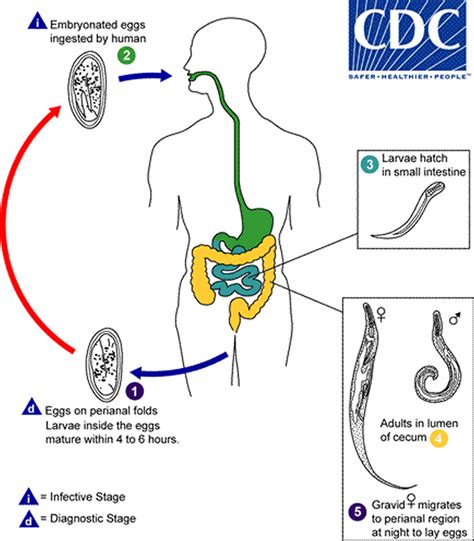 Pinworm Infection - Symptoms, Anus, Diagnosis, Treatment