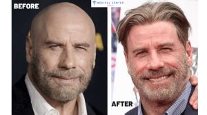 John Travolta's Hair Transplantation - MCT