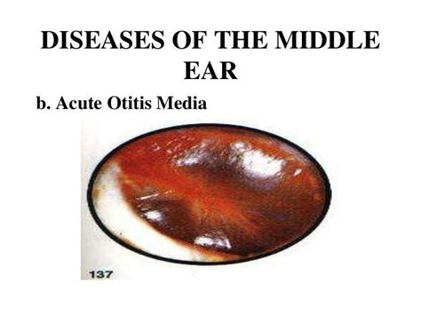 Common Ear Diseases