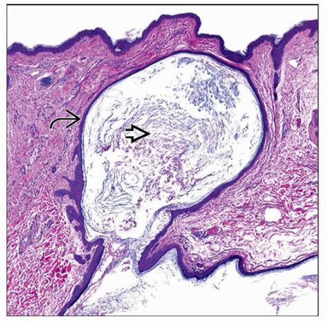 Epidermal Inclusion Cyst Histology