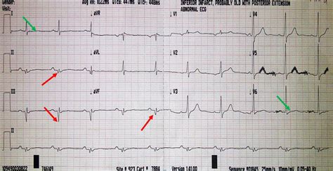 Pathological Q Wave