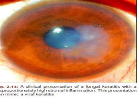 Fungal corneal ulcer