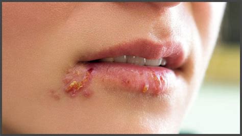 Shingles in mouth pictures | Shingles Expert