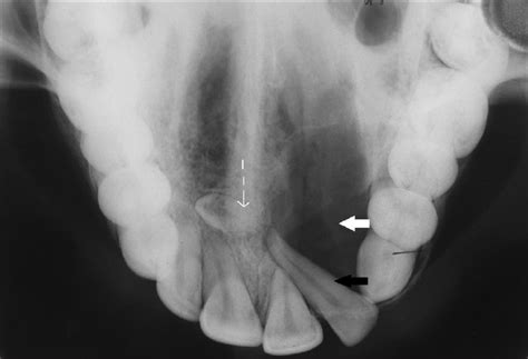 Maxillary occlusal view reveals unilocular radiolucency with a ...