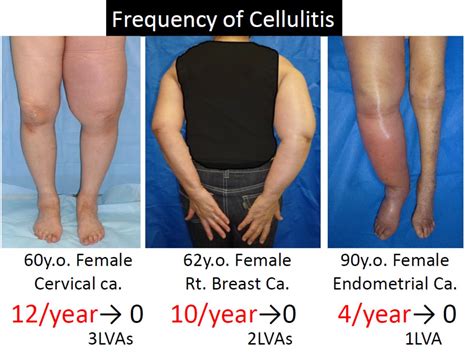 Cellulitis treatment and prevention - Mominoki Day Surgery Clinic in Japan