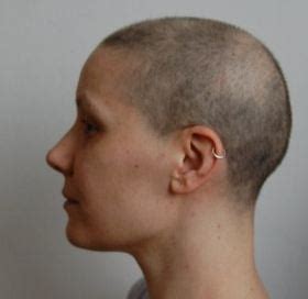 Hair Regrowth after Chemo – Pictures of Post Chemotherapy Growing Hair