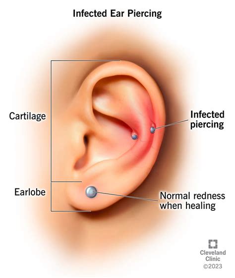 Infected Ear Piercing: Symptoms, Treatment Prevention, 44% OFF