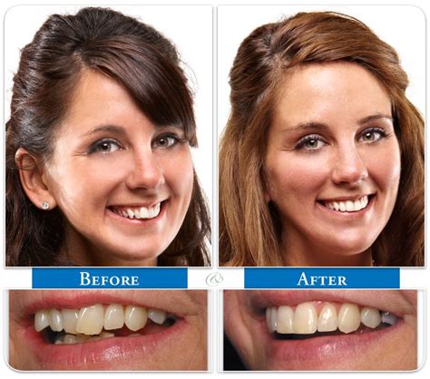 six month smiles before and after - guerradental.com