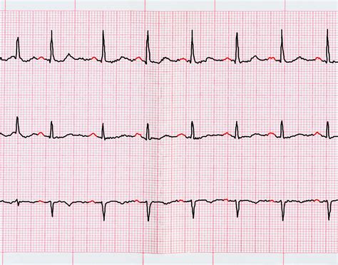 Atrial Fibrillation Mortality May Increase With Digoxin - The ...