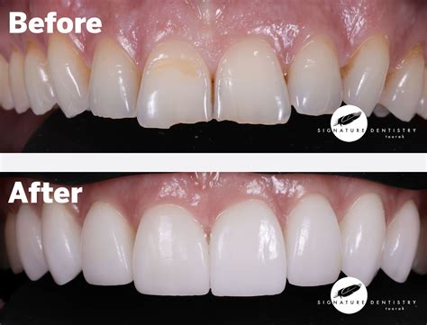 Veneers Before and After By Dr Kasen