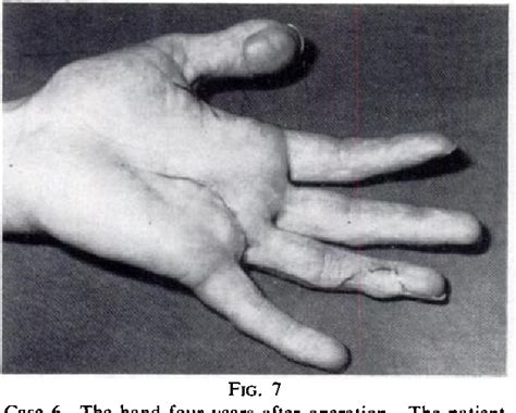 Figure 7 from The neurovascular island flap for defective sensibility ...