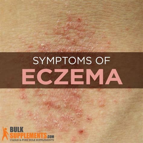 Eczema: Characteristics, Causes & Treatment