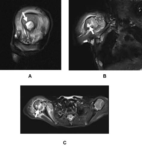 MRI showing bone marrow edema (white arrow) in the right shoulder in ...