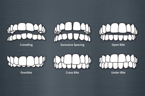 Indications for Clear Aligner - PhiAligner KnowledgeBase