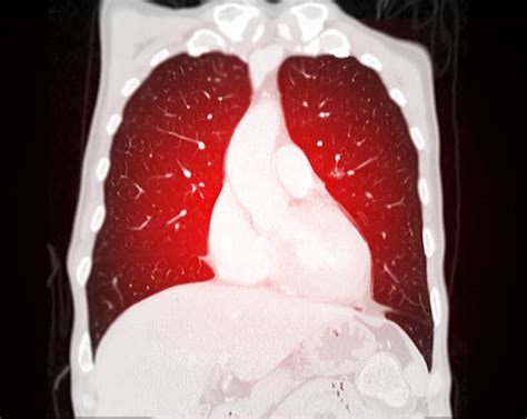 100+ Hilum Of Lung Stock Photos, Pictures & Royalty-Free Images - iStock