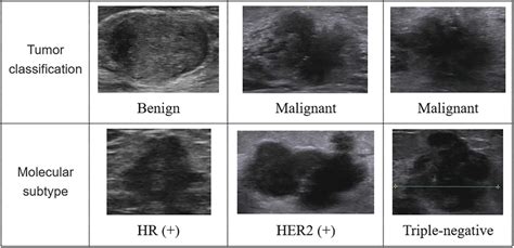 Some samples of breast ultrasound images from the datasets. In the ...