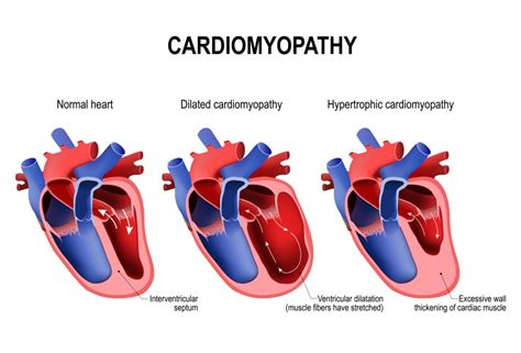 What Does it Mean to Have an Enlarged Heart ? - Health Beat