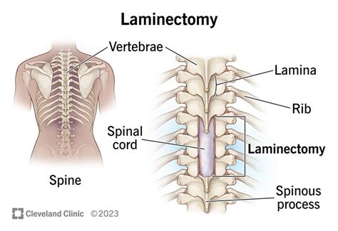 Laminectomy: What It Is, Procedure, Recovery & Complications