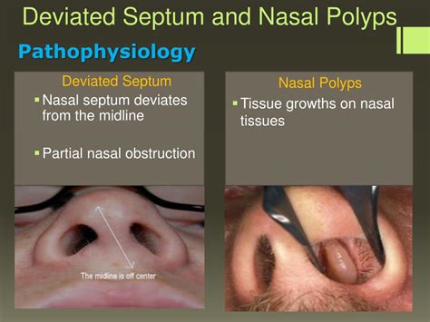 Nasal Polyps Symptoms Causes Treatment Bulksupplementscom