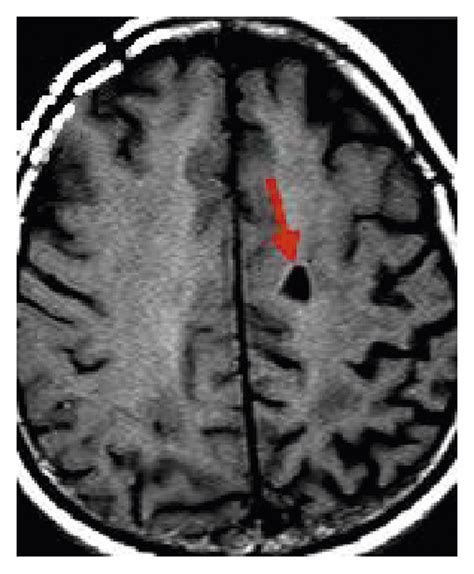 MRI image of asymptomatic cerebral infarction of a male patient aged 45 ...