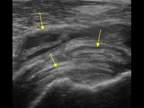 Musculoskeletal Joints and Tendons | 6.1 Shoulder : Case 6.1.3 Biceps ...