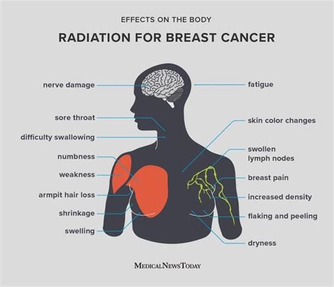 Radiation Therapy Side Effects