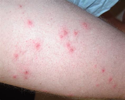 Folliculitis - Causes, Signs, Symptoms, How to Get Rid of Folliculitis