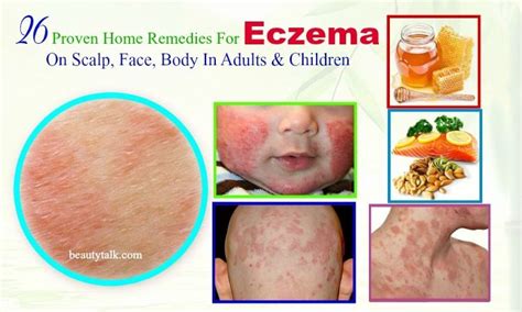 26 Proven Home Remedies For Eczema On Scalp In Adults & Kids