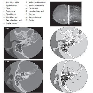 Temporal Bone - CT Scan - RadTechOnDuty