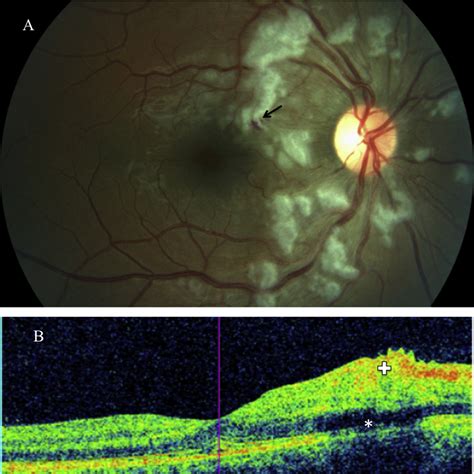 Purtscher's Retinopathy - Ophthalmology