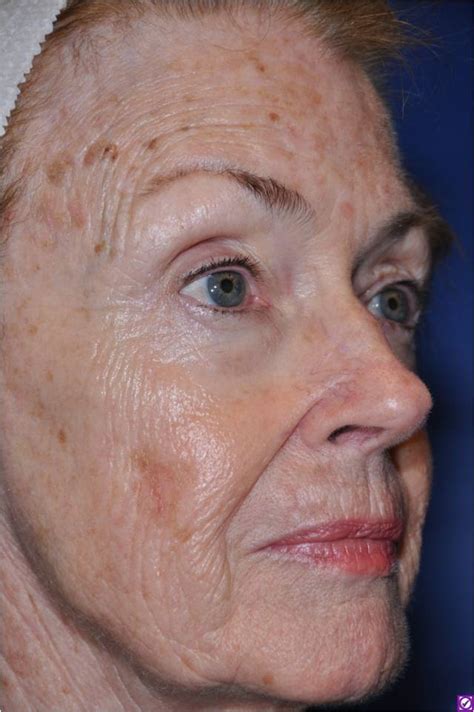 Aging Skin (photoaging skin) - Dermatology Advisor