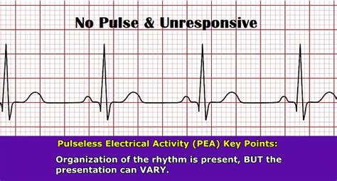 Sarah BSN, RN — Pulseless Electrical Activity (PEA) ECG/EKG Rhythm...