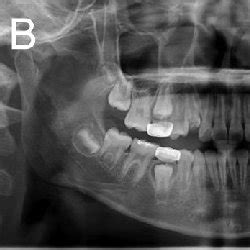 | (A) Intraoral radiograph showing a dentigerous cyst (arrowheads ...