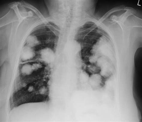 Lung metastases (2) - Radiology at St. Vincent's University Hospital