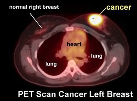 Breast Cancer Detection Techniques: Issues and Challenges | Journal of ...