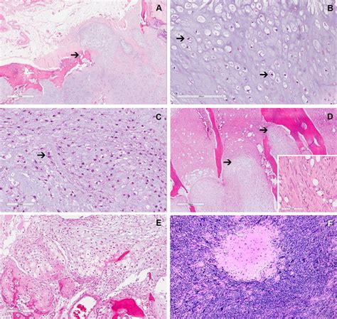 Chondrosarcoma Histology