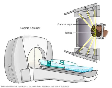 Brain stereotactic radiosurgery - Mayo Clinic