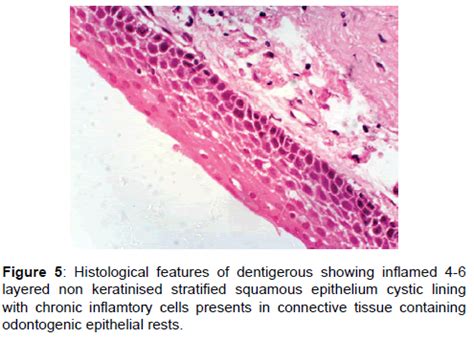 Dentigerous Cyst Histology