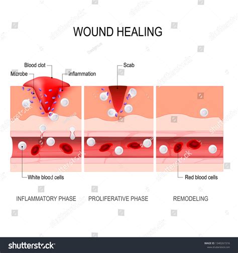 45 Wound Healing Inflammatory Phase Images, Stock Photos & Vectors ...