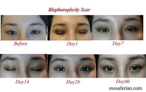 two week upper eyelid surgery recovery day by day Archives