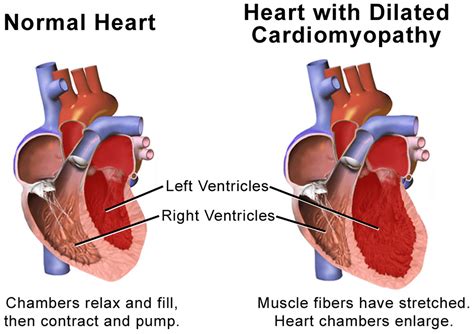 Dilated Cardiomyopathy - Causes, Signs, Symptoms, Treatment