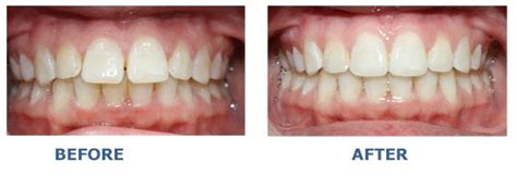 Magic of a Retainer: Before and After Photos to Prove It | New Health ...