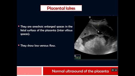 Placenta Lesions Imaging Sonography Placenta X Ray Ultrasound | The ...