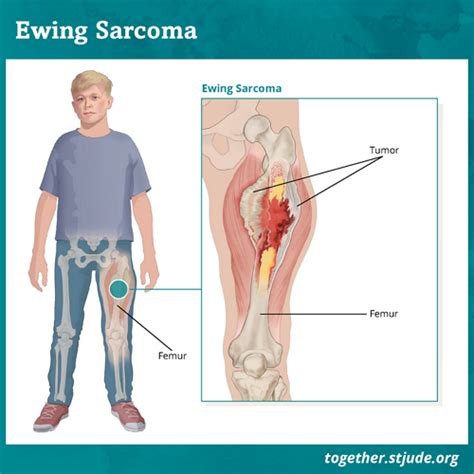 Ewing Sarcoma - Together by St. Jude™