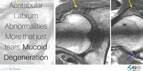 HIP ACETABULAR LABRUM MRI MORE THAN JUST TEARS: MUCOID DEGENERATION ...