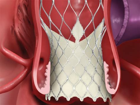 TAVR safe for small degenerating bioprosthetic aortic valves: study ...