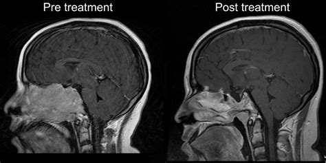 Invasive Giant Prolactinoma Presenting as a Nasal Polyp - The Journal ...