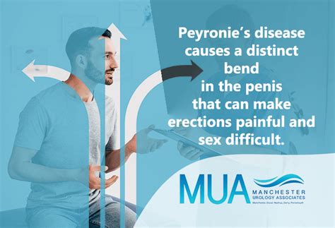 Peyronie’s Disease | Manchester Urology Associates, PA